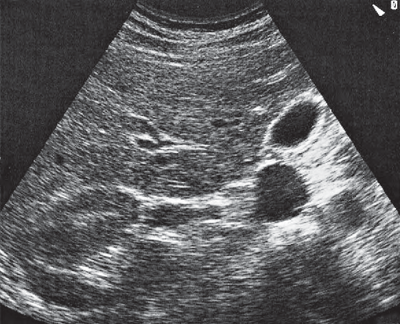 Duodenum ultrasound image, Renal artery