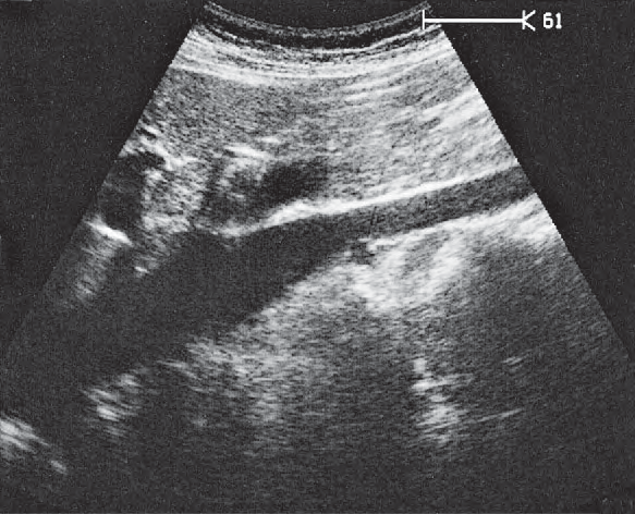 Spinal column ultrasound image, Vena cava