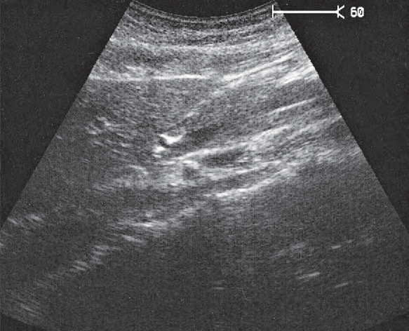 Left renal vein ultrasound image, Right renal artery and left renal vein