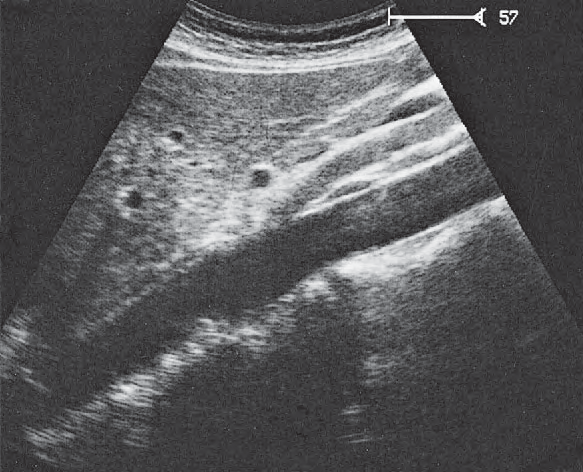 Left renal vein ultrasound image, Aorta and left renal vein