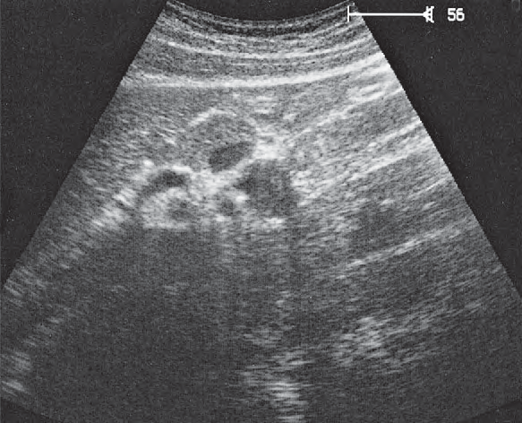 Left renal artery ultrasound image, Left renal vessels, splenic artery and vein