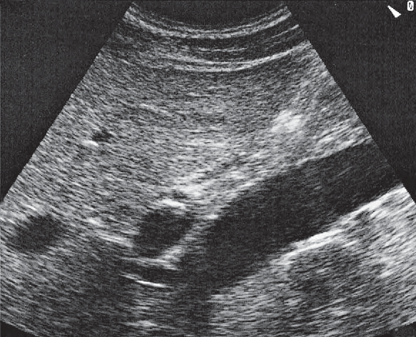Middle hepatic vein ultrasound image, Portal vein, vena cava, right renal artery