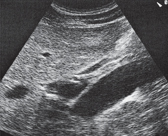 Bile Duct Ultrasound Anatomy