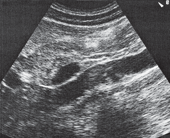 Middle hepatic vein ultrasound image, Portal vein, vena cava, and bile duct
