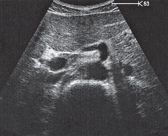 Hepatic Artery Ultrasound Anatomy