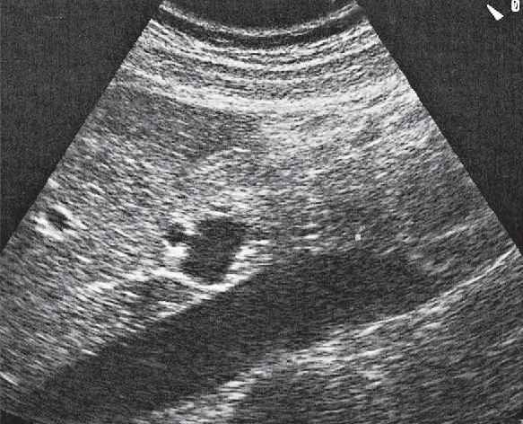 Pancreatic duct ultrasound image, Portal vein and hepatic artery