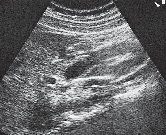 Stomach ultrasound image, Hepatic artery, superior mesenteric vein