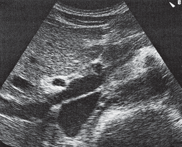 Middle hepatic vein ultrasound image, Hepatic artery, portal vein, vena cava