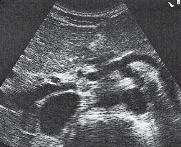 Spinal column ultrasound image, Hepatic artery, bile duct, portal vein