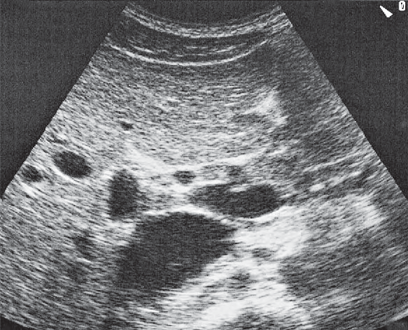 Gallbladder Ultrasound Anatomy