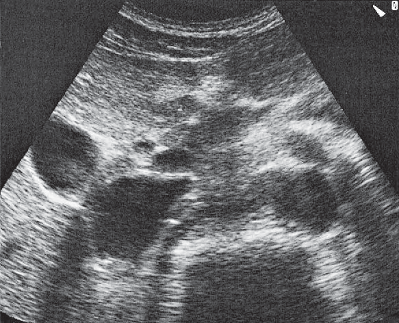 Gallbladder ultrasound image, Bile duct, gallbladder, superior mesenteric vein