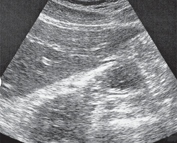 Lateral Segment Ultrasound Anatomy