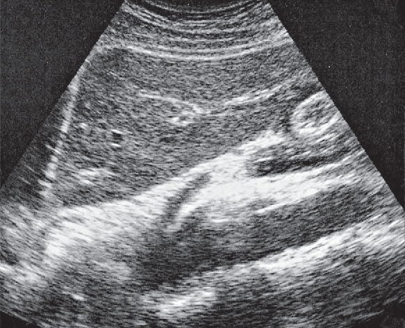 Left renal vein ultrasound image, Left lobe of liver, ligamentum teres, boundary between lateral and medial segments