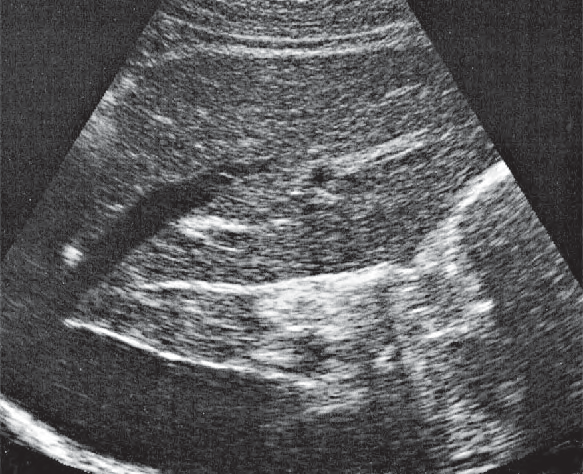 Ligamentum Venosum Ultrasound Anatomy