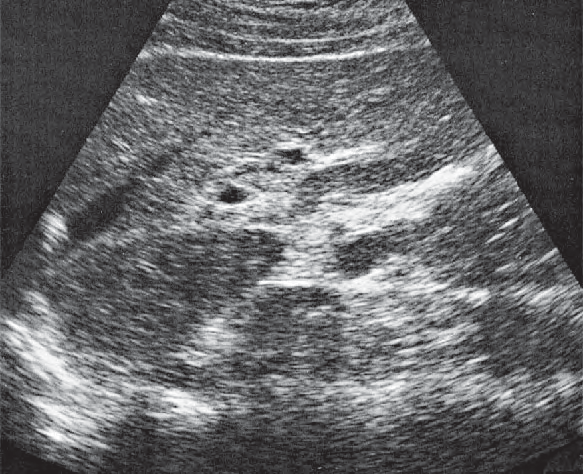 Left Hepatic Vein Ultrasound Anatomy