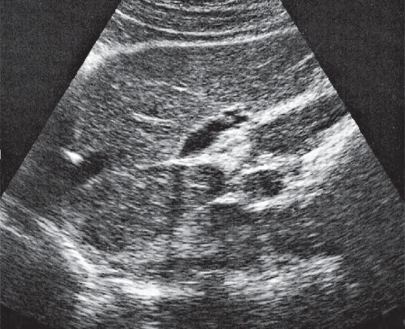 Caudate lobe ultrasound image, Left hepatic vein, ligamentum teres, boundary between lateral and medial segments, caudate lobe