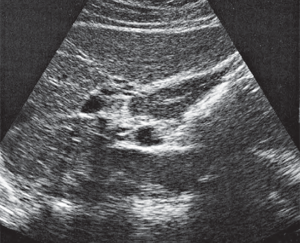 Gas ultrasound image, Left hepatic vein, ligamentum teres, boundary between lateral and medial segments, caudate lobe