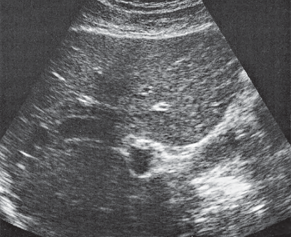Medial Segment Ultrasound Anatomy