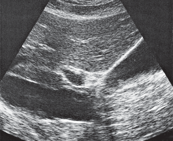 Middle hepatic vein ultrasound image, Gallbladder, portal vein, vena cava, boundary between medial and anterior segments