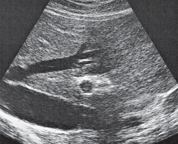 Anterior Segment Ultrasound Anatomy