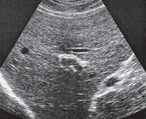 Right Hepatic Vein Ultrasound Anatomy