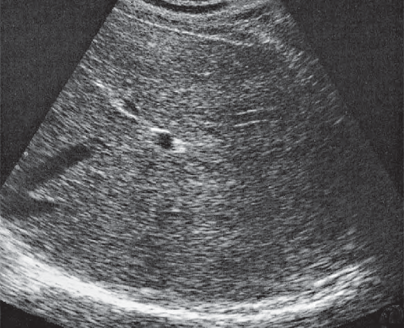 Posterior Segment Ultrasound Anatomy