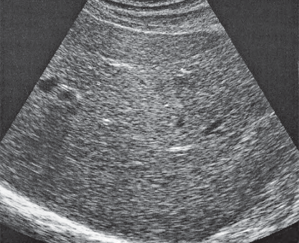 Renal Pelvis Ultrasound Anatomy