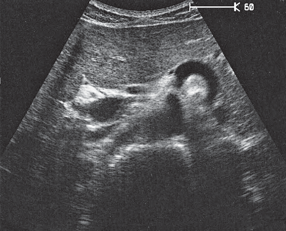 Left Kidney Ultrasound Anatomy