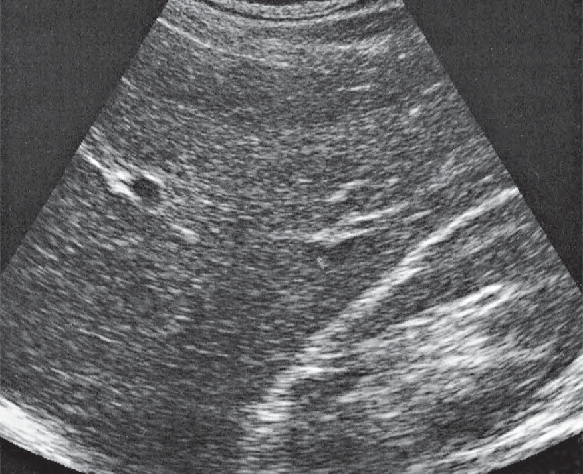 Lateral segment ultrasound image, Posterior segment, lateral portions of liver, kidney