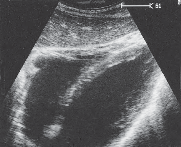 Lateral segment ultrasound image, Left lobe of liver, lateral segment, heart