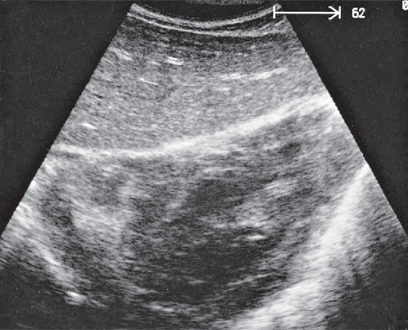 Lateral segment ultrasound image, Left lobe of liver, lateral segment, heart
