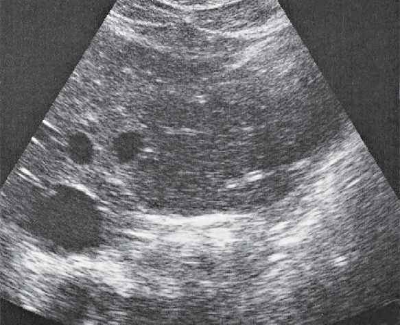 Lateral segment ultrasound image, Left lobe of liver, lateral segment, hepatic veins