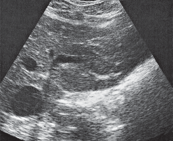 Lateral segment ultrasound image, Left lobe of liver, lateral segment, caudate lobe