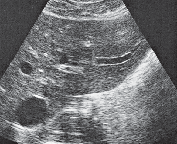 Lateral segment ultrasound image, Left lobe of liver, lateral segment, caudate lobe