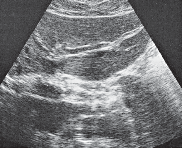 Lateral segment ultrasound image, Left lobe of liver, lateral segment, left portal vein branch