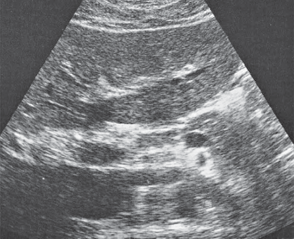 Lateral segment ultrasound image, Left lobe of liver, lateral segment, ligamentum teres