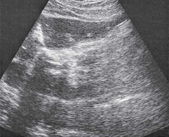 Lateral segment ultrasound image, Left lobe of liver, subsegment III, ligamentum teres