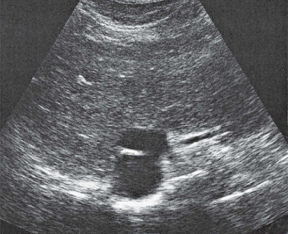 Left lobe of liver ultrasound image, Medial and anterior hepatic segments, opening of hepatic veins