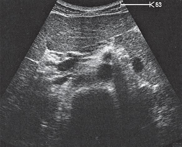 Quadrate lobe ultrasound image, Superior mesenteric artery
