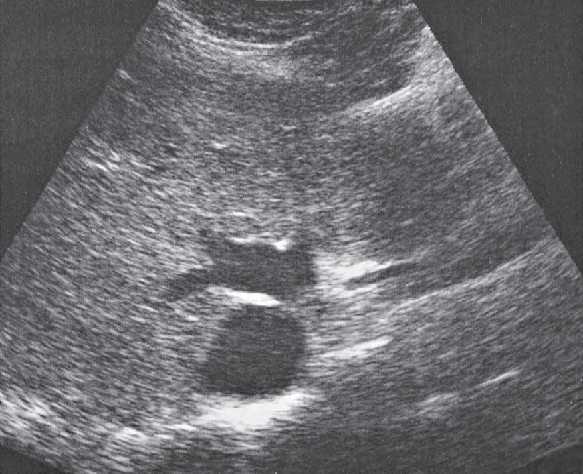 Middle hepatic vein ultrasound image, Medial and anterior hepatic segments, opening of hepatic veins