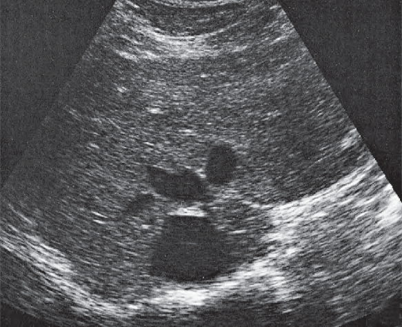 Caudate lobe ultrasound image, Medial and anterior hepatic segments, hepatic veins, caudate lobe