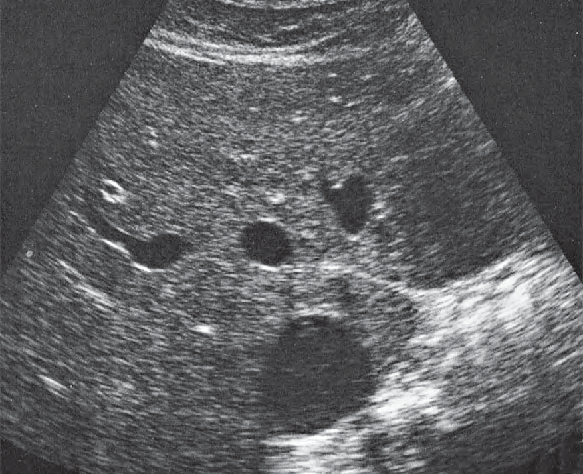 Gas ultrasound image, Medial and anterior hepatic segments, hepatic veins, caudate lobe
