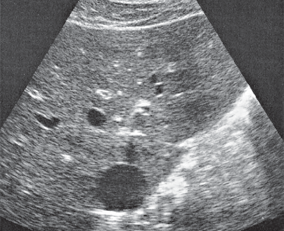 Gas ultrasound image, Medial and anterior hepatic segments, caudate lobe
