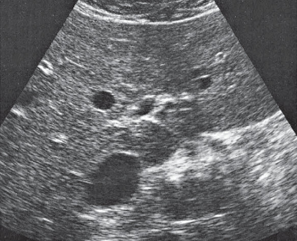 Caudate lobe ultrasound image, Medial and anterior hepatic segments, left portal vein branch, caudate lobe