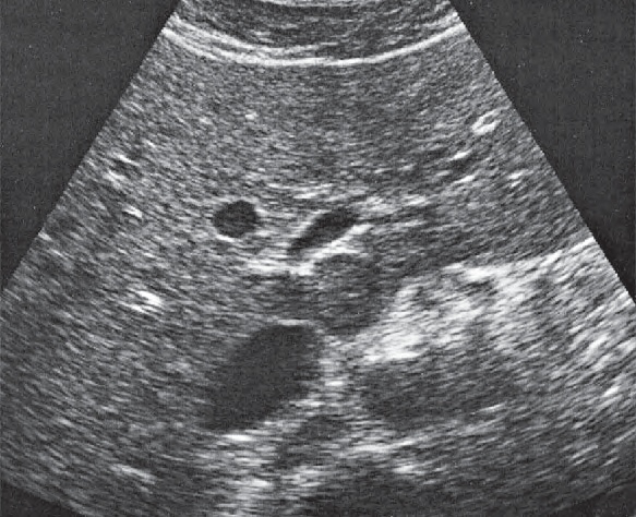 Caudate lobe ultrasound image, Medial and anterior hepatic segments, left portal vein branch, caudate lobe