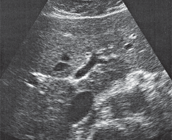 Middle hepatic vein ultrasound image, Medial and anterior hepatic segments, left portal vein branch, caudate lobe