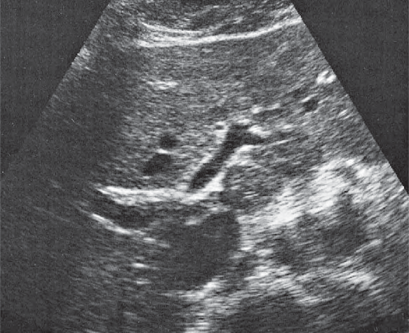 Middle hepatic vein ultrasound image, Medial and anterior hepatic segments, bifurcation of portal vein