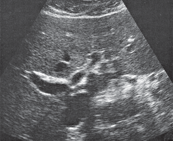 Middle hepatic vein ultrasound image, Medial and anterior hepatic segments, bifurcation of portal vein