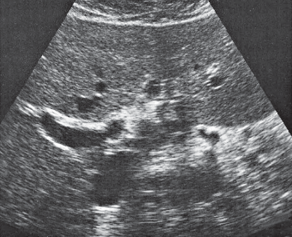 Middle hepatic vein ultrasound image, Medial and anterior hepatic segments, right portal vein branch