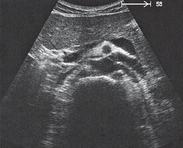 Splenic Vein Ultrasound Anatomy